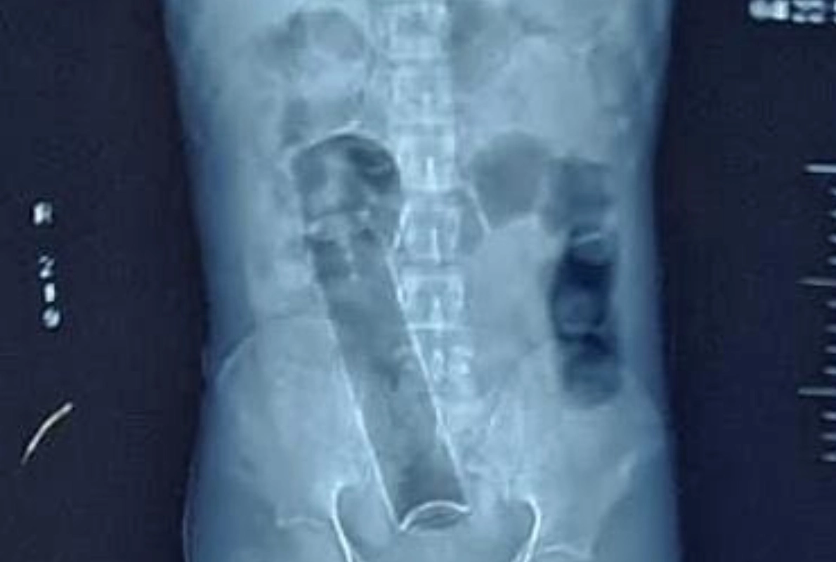 Shocking: He swallowed a 7.5-inch-long bottle of deodorant. What happened next?