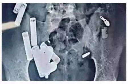 Shocking: ಹೊಟ್ಟೆಯಲ್ಲಿದ್ದವು 65 ಲೋಹದ ವಸ್ತುಗಳು: ಹೊರತೆಗೆದ ತಕ್ಷಣವೇ 14 ವರ್ಷದ ಬಾಲಕ ಸಾವು