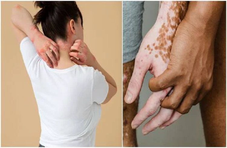 World Psoriasis Day :`ಸೋರಿಯಾಸಿಸ್’ ಕಾಯಿಲೆಯ ಲಕ್ಷಣಗಳು, ಚಿಕಿತ್ಸಾ ವಿಧಾನಗಳ ಕುರಿತು ಇಲ್ಲಿದೆ ಮಾಹಿತಿ
