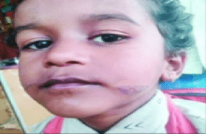 BREAKING : ಶಿವಮೊಗ್ಗದಲ್ಲಿ ಅಮಾನವೀಯ ಘಟನೆ : ಕಾದ ಚಾಕುವಿನಿಂದ ಮಗು ಗಲ್ಲಕ್ಕೆ ಬರೆ ಎಳೆದ ಅಂಗನವಾಡಿ ಸಹಾಯಕಿ!