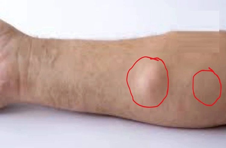 ಗಮನಿಸಿ : ದೇಹದ ಮೇಲೆ `ಕೊಬ್ಬಿನ ಗಡ್ಡೆ’ ಇದ್ರೆ ಜಸ್ಟ್ ಹೀಗೆ ಮಾಡಿ : ತಾನಾಗೆ ಕರಗುತ್ತೆ.!