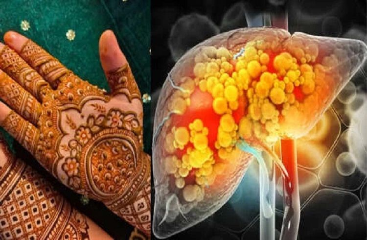 `ಹೆನ್ನಾ ಡೈ’ ಯಕೃತ್ತಿನ ಕಾಯಿಲೆಗೆ ಚಿಕಿತ್ಸೆ ನೀಡಬಲ್ಲದು : ಅಧ್ಯಯನ