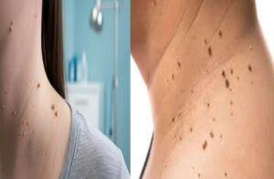 ಗಮನಿಸಿ : ದೇಹದ ಮೇಲಿನ `ನರುಳ್ಳೆ’ ತಾವಾಗಿಯೇ ಉದುರಿಹೋಗಬೇಕೇ? ಜಸ್ಟ್ ಅರ್ಧ ಚಮಚ `ಟೂತ್ ಪೇಸ್ಟ್’ ಸಾಕು.!