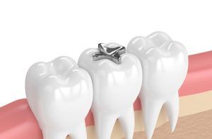 ‘ಬೆಳ್ಳಿ ಫಿಲ್ಲಿಂಗ್’ಗೆ ಗುಡ್ ಬೈ ; 2034ರ ವೇಳೆಗೆ ದಂತವೈದ್ಯಶಾಸ್ತ್ರದಲ್ಲಿ ‘ಪಾದರಸ ಬಳಕೆ’ ಕೊನೆಗೆ ಒಪ್ಪಿಗೆ!