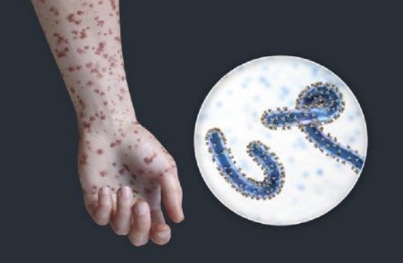 SHOCKING : ವಿಶ್ವದಾದ್ಯಂತ ಭೀತಿ ಸೃಷ್ಟಿಸಿದ 60 ವರ್ಷದ ಹಳೆಯ ಅಪಾಯಕಾರಿ ವೈರಸ್ : ಈ ದೇಶಗಳಲ್ಲಿ ಹೊಸ ಕೇಸ್ ದಾಖಲು.!