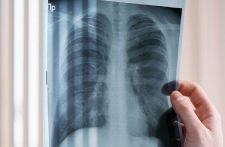 SHOCKING: ಧೂಮಪಾನ ಮಾಡದವರಲ್ಲೂ ‘ಶ್ವಾಸಕೋಶದ ಕ್ಯಾನ್ಸರ್’ ಪ್ರಕರಣಗಳು ಹೆಚ್ಚುತ್ತಿವೆ: ಅಧ್ಯಯನ ವರದಿ | Lung Cancer