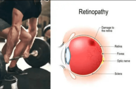 Shocking: ವರ್ಕೌಟ್ ಮಾಡುತ್ತಿದ್ದಾಗಲೇ ದೃಷ್ಟಿ ಕಳೆದುಕೊಂಡ ಯುವಕ !