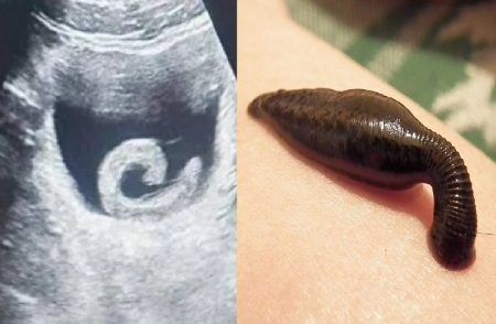 ALERT : `ಆನ್ ಲೈನ್’ ನೋಡಿ ಚಿಕಿತ್ಸೆ ಪಡೆಯುವವರೇ ಎಚ್ಚರ : ದೇಹದೊಳಗೆ ಜೀವಂತ `ಜಿಗಣಿ ಹುಳ’ ಸೇರಿಸಿಕೊಂಡ ಯುವಕ.!