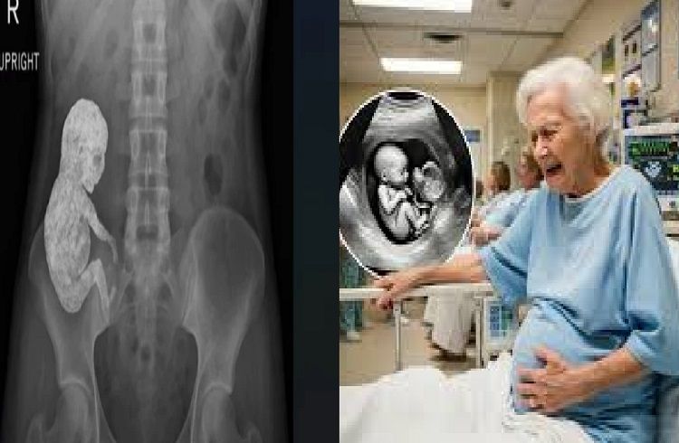 SHOCKING : ಹೊಟ್ಟೆನೋವೆಂದು ಆಸ್ಪತ್ರೆಗೆ ಹೋದ 82 ವರ್ಷದ ಅಜ್ಜಿಯ ಹೊಟ್ಟೆಯಲ್ಲಿತ್ತು 40 ವರ್ಷದ ಮಗು : ಎಕ್ಸ್-ರೇ ನೋಡಿದ ವೈದ್ಯರೇ ಶಾಕ್.!