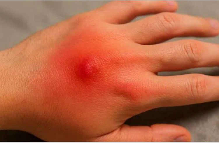 ‘ಜೇಡ ಕಡಿತ’ ಅಪಾಯಕಾರಿಯೇ.? ಜೇಡ ಕಚ್ಚಿದ್ರೆ ಏನಾಗುತ್ತೆ ಗೊತ್ತಾ?