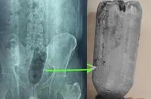 SHOCKING : ಖಾಸಗಿ ಅಂಗದಲ್ಲಿ `ನೀರಿನ ಬಾಟಲ್’ ಸೇರಿಸಿಕೊಂಡ ವ್ಯಕ್ತಿ : `ಎಕ್ಸ್ ರೇ’ ನೋಡಿ ವೈದ್ಯರೇ ಶಾಕ್ !