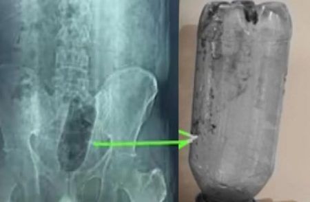 SHOCKING : ಖಾಸಗಿ ಅಂಗದಲ್ಲಿ `ನೀರಿನ ಬಾಟಲ್’ ಸೇರಿಸಿಕೊಂಡ ವ್ಯಕ್ತಿ : `ಎಕ್ಸ್ ರೇ’ ನೋಡಿ ವೈದ್ಯರೇ ಶಾಕ್ !