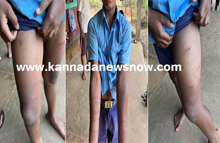 ಶಿಕ್ಷಕರೋ ಅಥವಾ ಸಂಸ್ಕಾರಹೀನರೋ?; ವಿದ್ಯಾರ್ಥಿಯ ರಕ್ತಸಿಕ್ತ ಬೆನ್ನಿಗೆ ‘ಬ್ಯಾಡ್ ಕ್ಯಾರೆಕ್ಟರ್’ ಪಟ್ಟ ಕಟ್ಟುವ ಕುತಂತ್ರ!