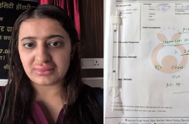 SHOCKING : ವಂದೇ ಭಾರತ್ ರೈಲಿನಲ್ಲಿ ಕಳಪೆ ಆಹಾರ ಸೇವನೆ: ಮಹಿಳೆಯ ತುಟಿಗಳಲ್ಲಿ ಊತ, ಮಗನಿಗೆ ಅತಿಸಾರ!